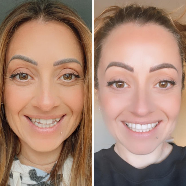 Invisalign® Before and After – Case 02 Invisalign® Before and After - Case 02