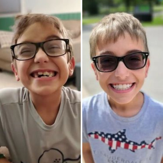 Invisalign® Before and After – Case 03 Invisalign® Before and After - Case 03