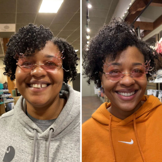 Invisalign® Before and After – Case 04 Invisalign® Before and After - Case 04