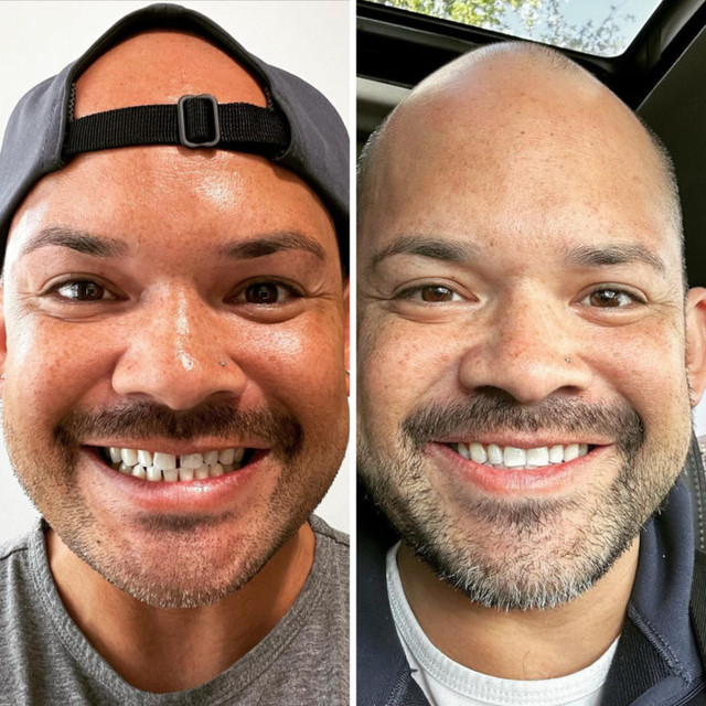Invisalign® Before and After – Case 05 Invisalign® Before and After - Case 05