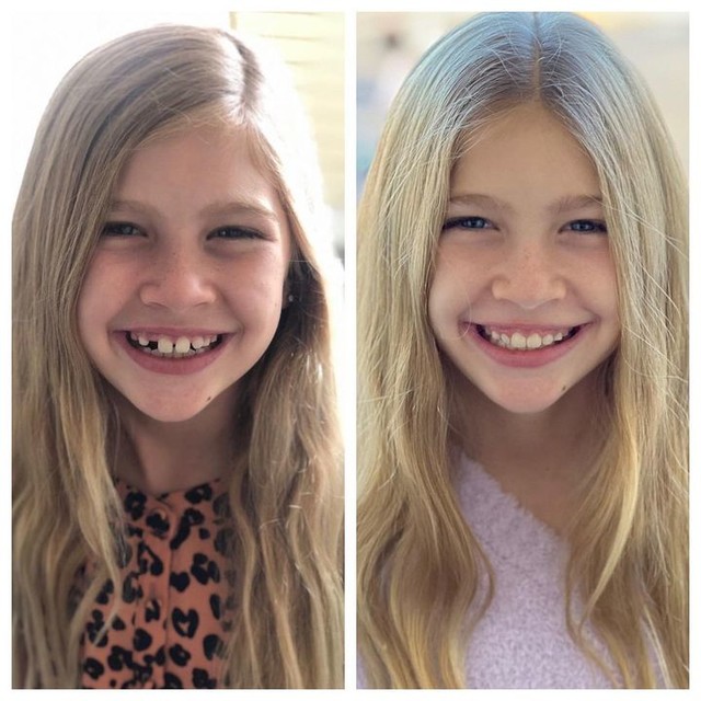 Invisalign® Before and After – Case 06 Invisalign® Before and After - Case 06