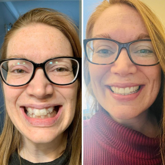 Invisalign® Before and After – Case 07 Invisalign® Before and After - Case 07