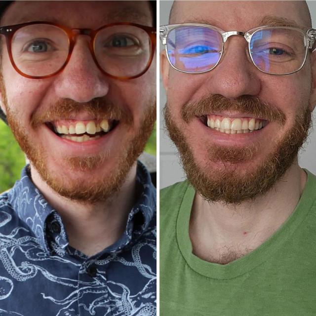 Invisalign® Before and After – Case 08 Invisalign® Before and After - Case 08
