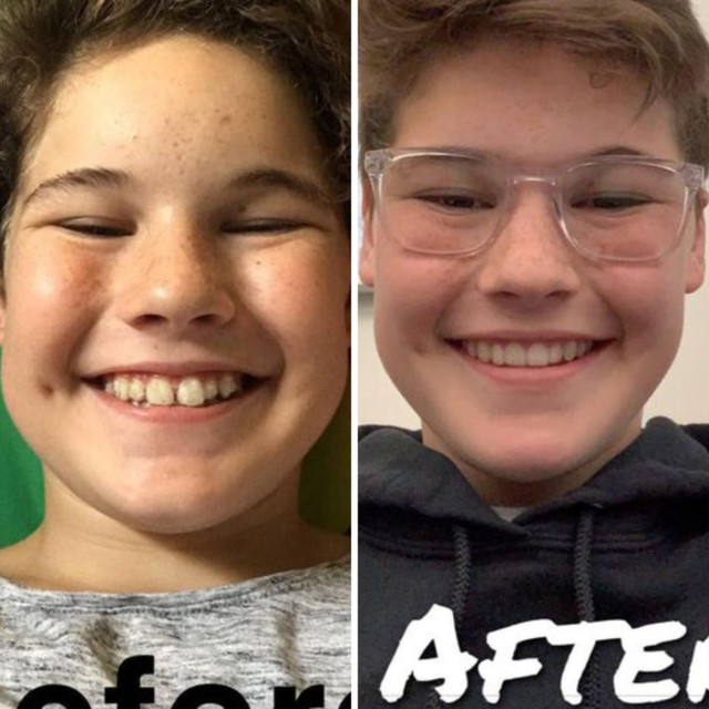 Invisalign® Before and After – Case 09 Invisalign® Before and After - Case 09