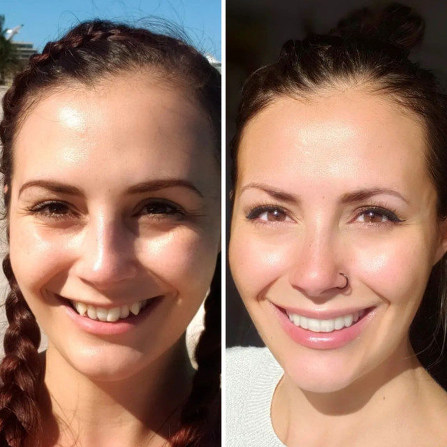 Invisalign® Before and After – Case 10 Invisalign® Before and After - Case 10