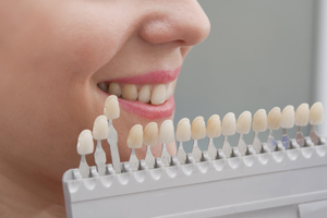 Matching tooth Shade