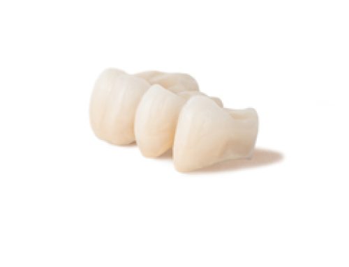 Caring for a Dental Bridge