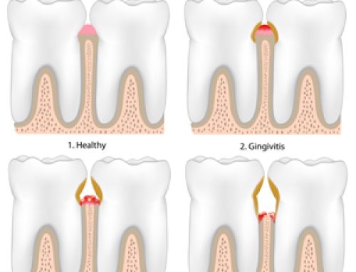 What to Know About Gum Disease